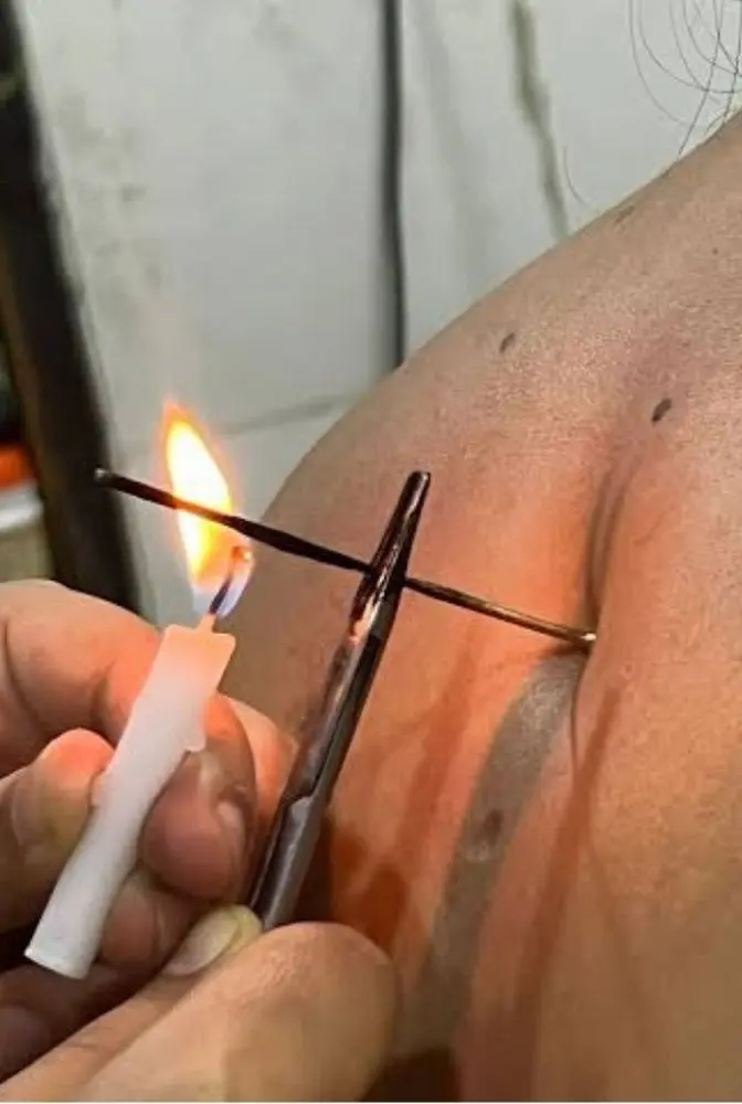 Agnikarma